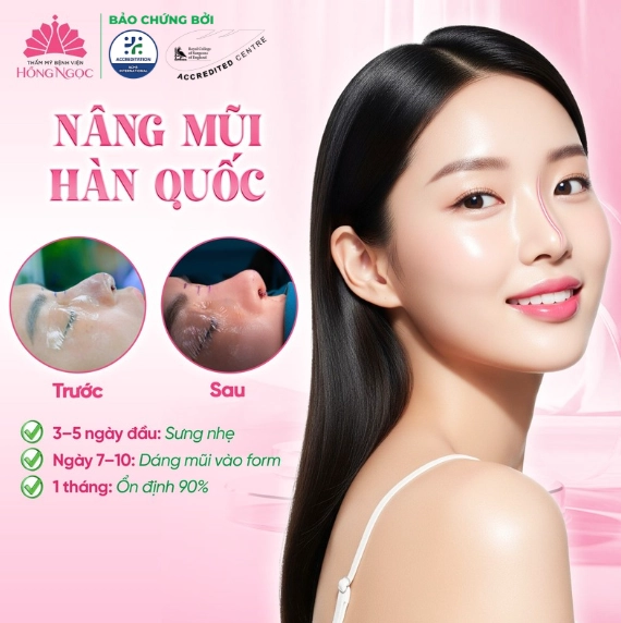 Nâng mũi - Phương pháp chủ lực tại Thẩm mỹ Bệnh viện Hồng Ngọc