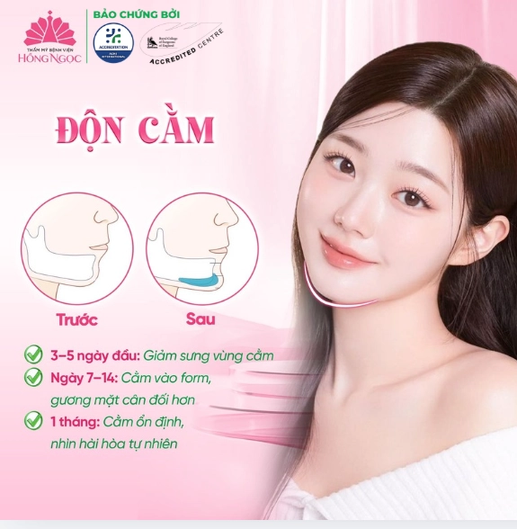 Độn cằm tại Thẩm mỹ Bệnh viện Hồng Ngọc
