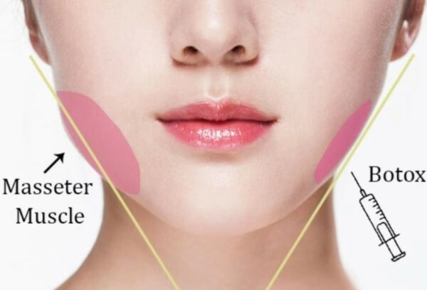 Tiêm botox gọn hàm giúp tạo gương mặt V-line tự nhiên