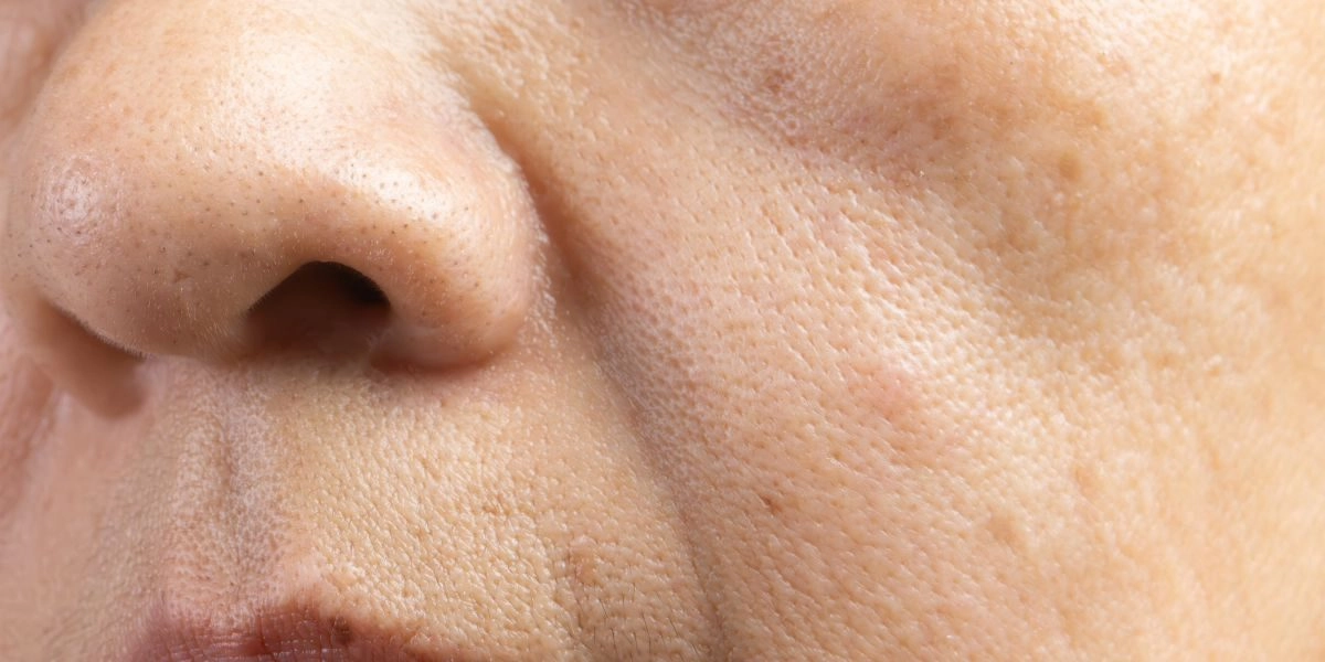 Hình ảnh làn da có dấu hiệu lão hóa do tuổi tác