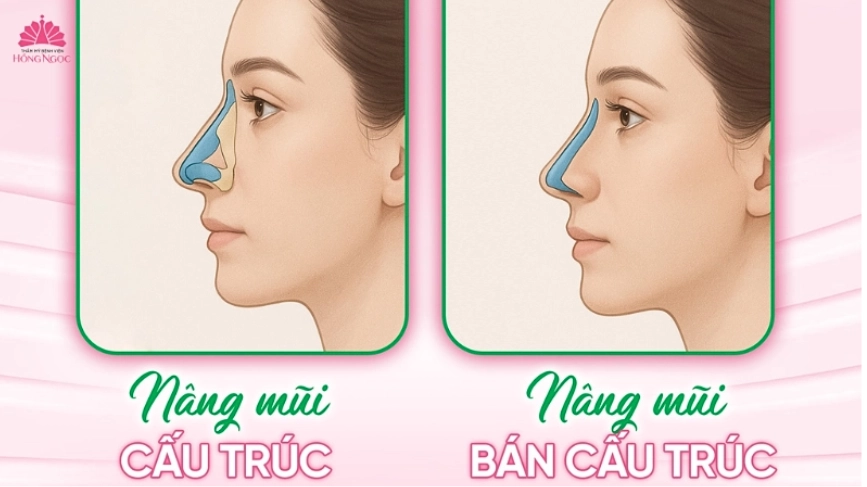 nâng mũi hàn quốc