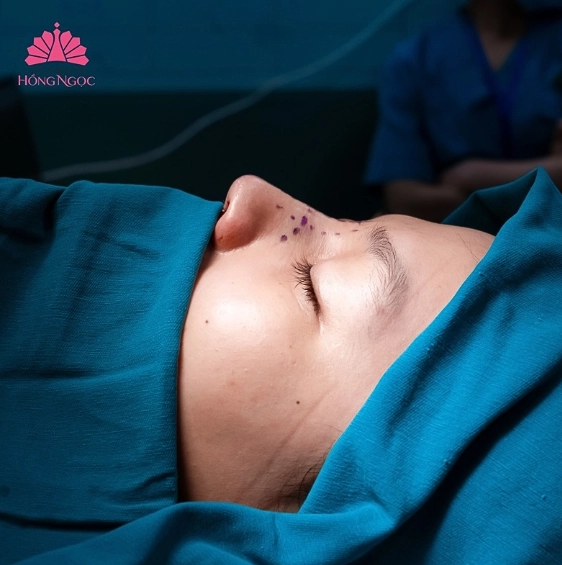 sửa mũi lệch