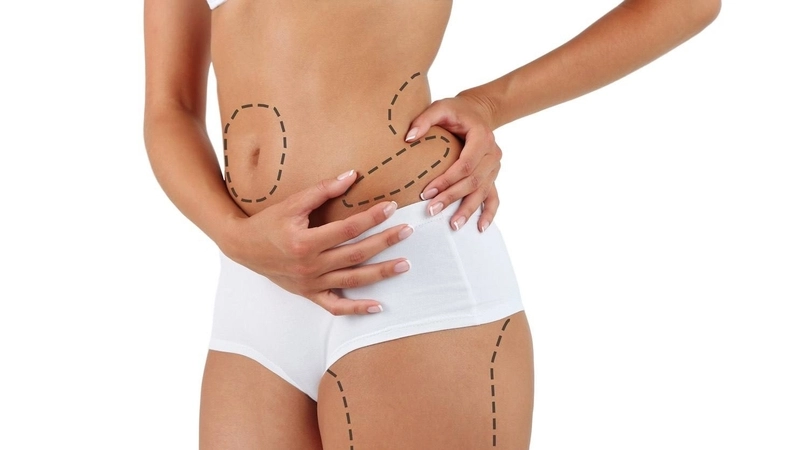Những vùng có thể thực hiện hút mỡ toàn thân&nbsp;