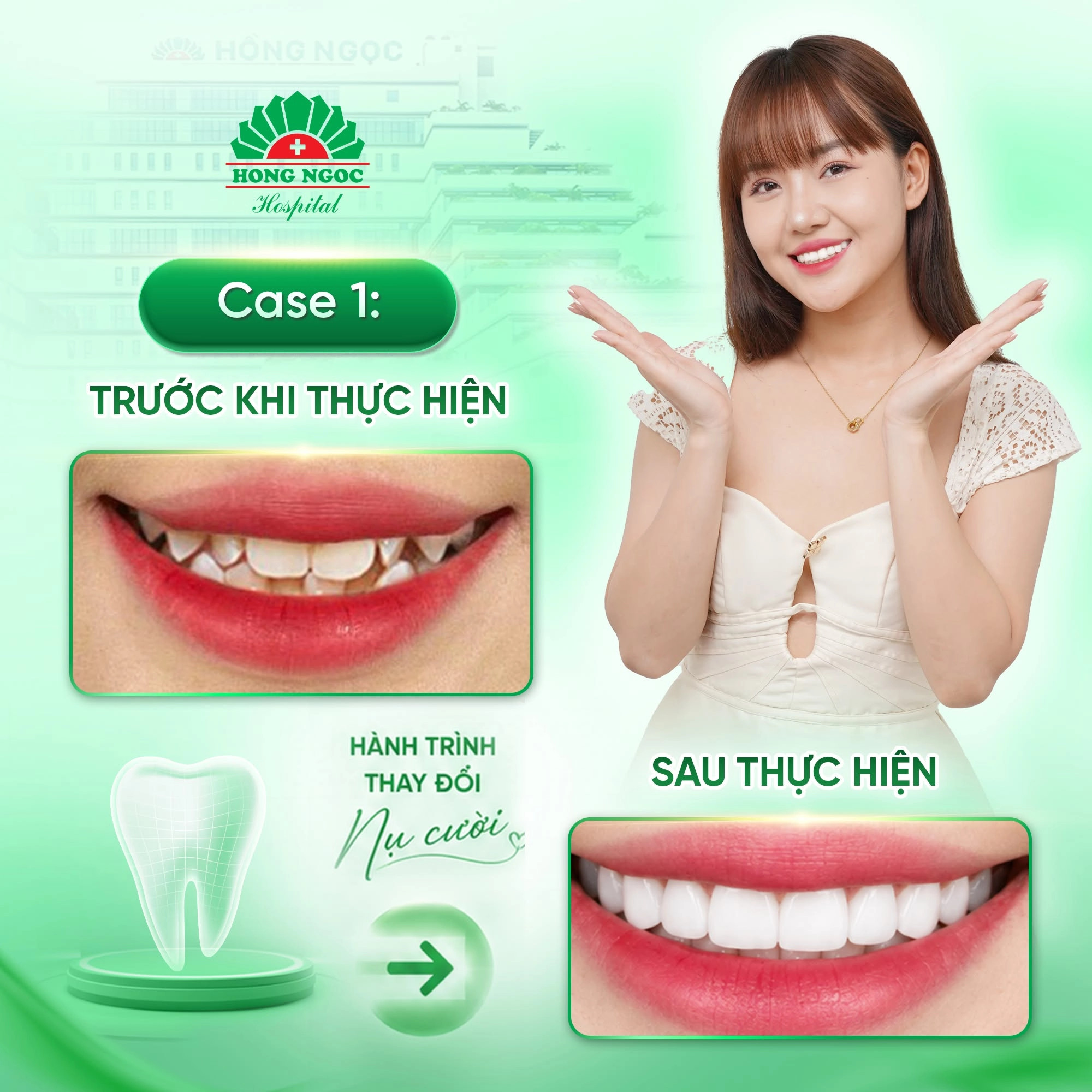 Ưu điểm của bọc răng sứ giúp cải thiện thẩm mỹ vượt trội 