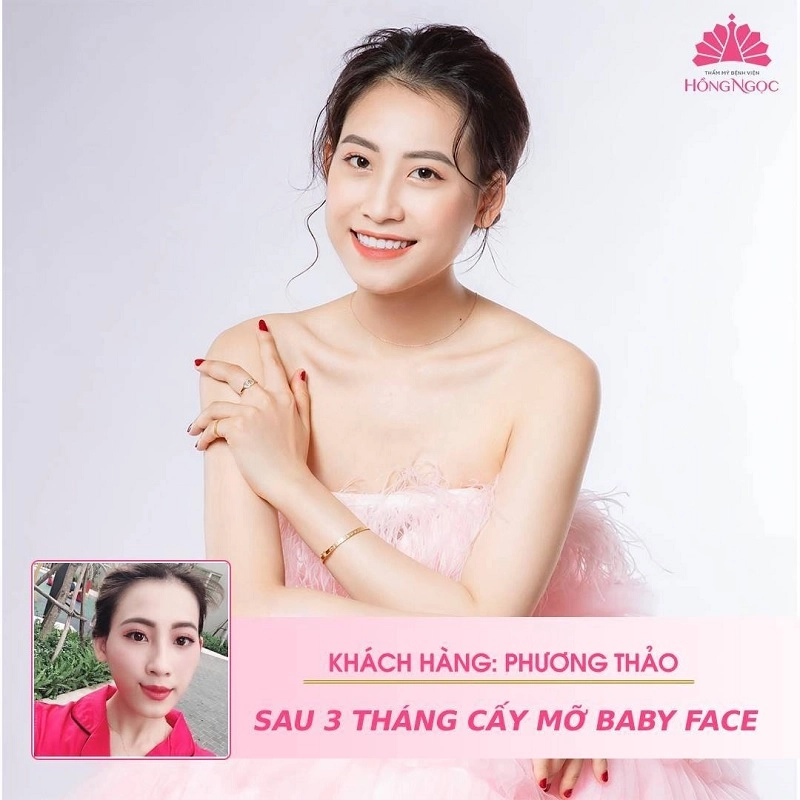 khách hàng chọn cấy mỡ tại hồng ngọc