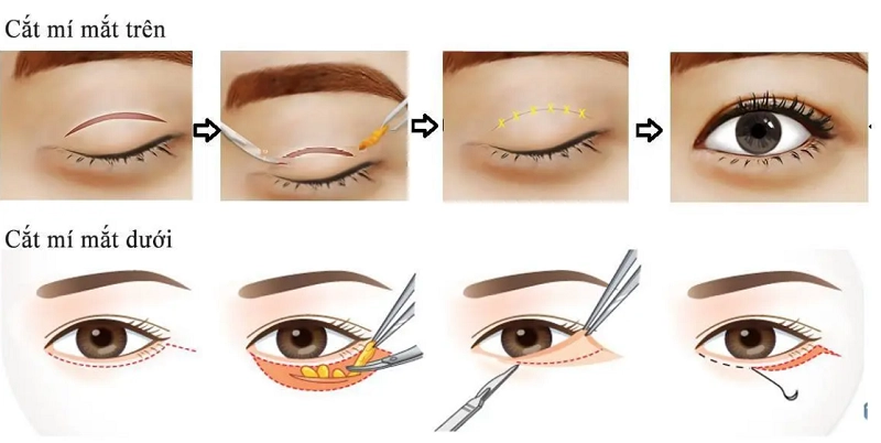 Các yếu tố ảnh hưởng đến chi phí cắt mí