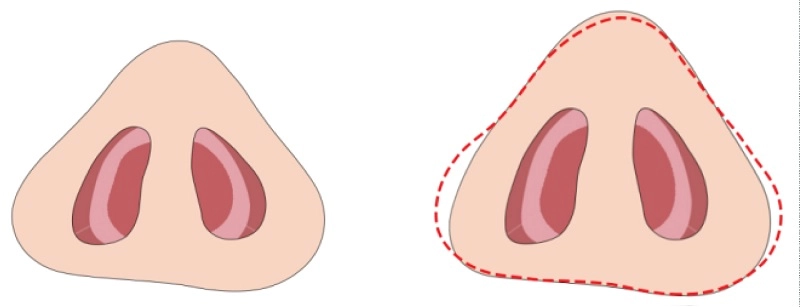 kỹ thuật thu gọn cánh mũi