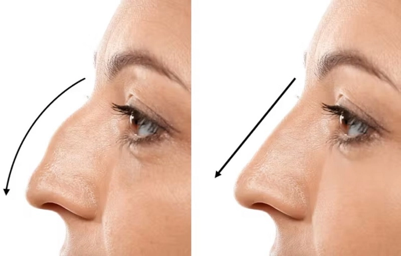 kỹ thuật và phương pháp nâng mũi