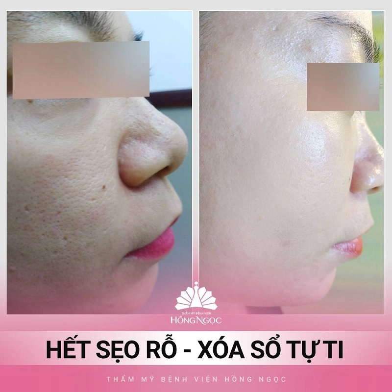 lăn kim điều trị sẹo