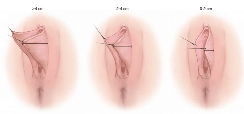 lão hóa mô vùng kín