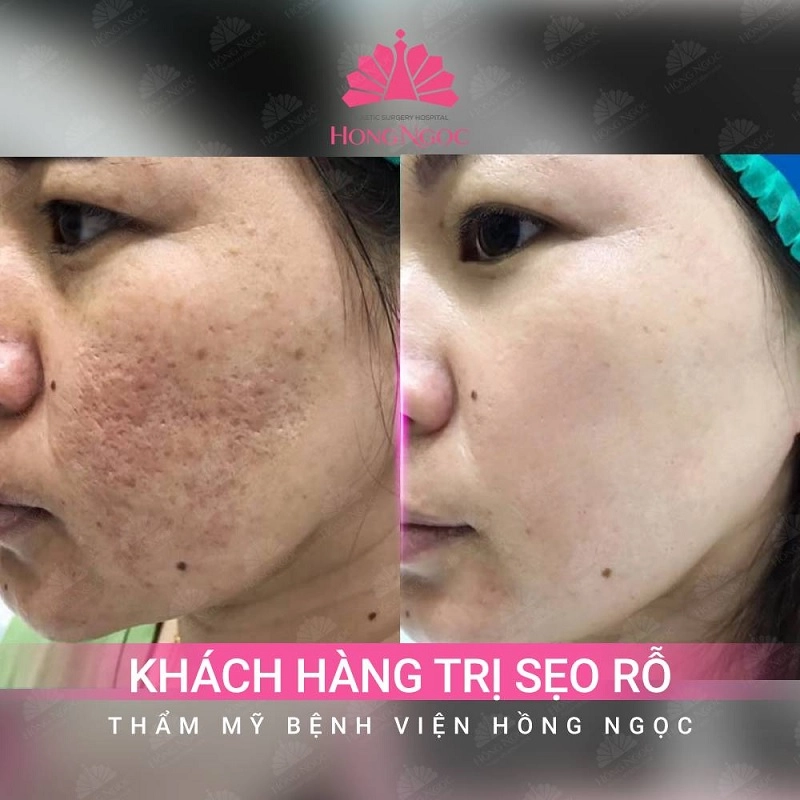 laser tái tạo bề mặt da