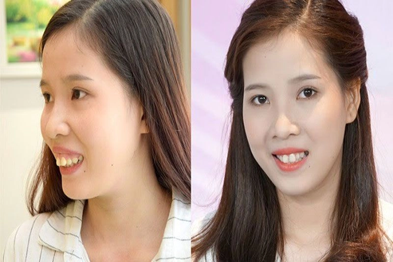 lợi ích của phẫu thuật hàm hô