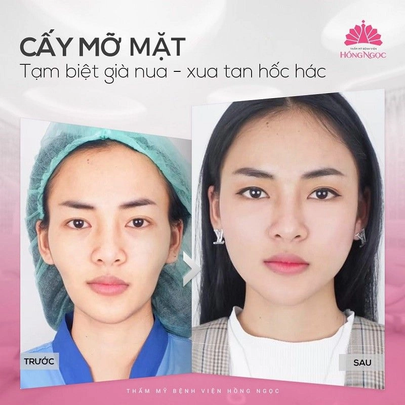 lưu ý khi cấy mỡ mặt