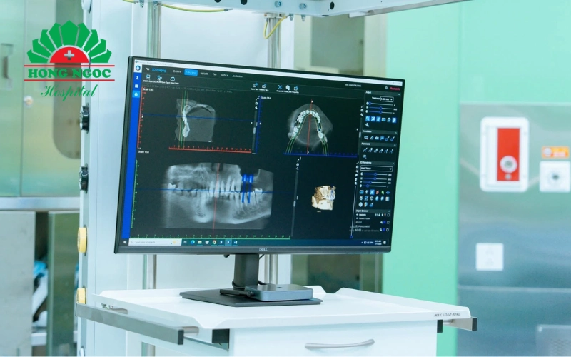 Vì sao nên chọn trồng răng Implant tại Răng Hàm Mặt Hồng Ngọc?