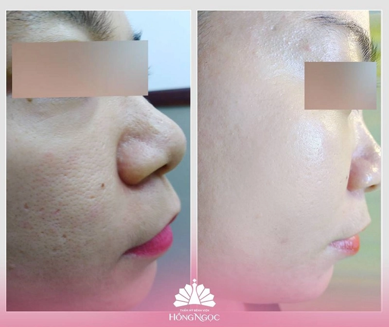 Mesotherapy làm đầy chân sẹo