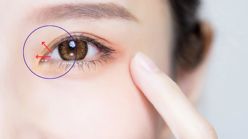 mỏ rộng khóe mắt