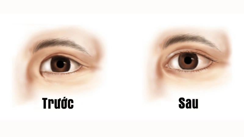 mỏ rộng khóe mắt