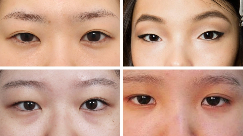 mỏ rộng khóe mắt