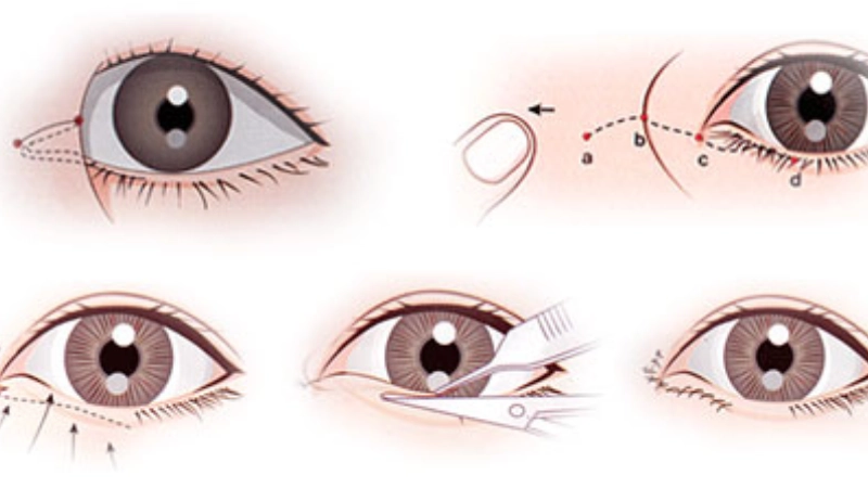 mở rộng khóe mắt