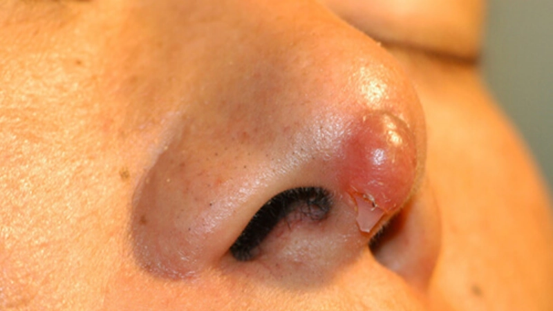 chỉnh sửa mũi hỏng