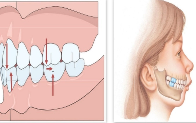 Tác hại của răng hô, móm nếu không điều trị
