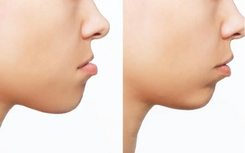 Lợi ích của việc điều trị hàm hô, hàm món sớm