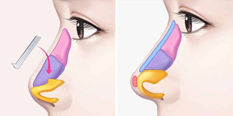 nâng mũi bán cấu trúc là gì