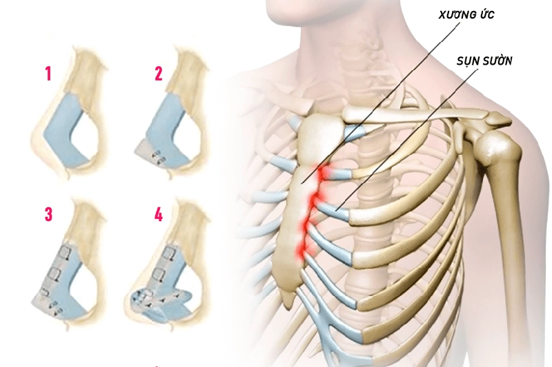 Chi phí nâng mũi sụn sườn hiện nay dao động khoảng 30-120 triệu đồng