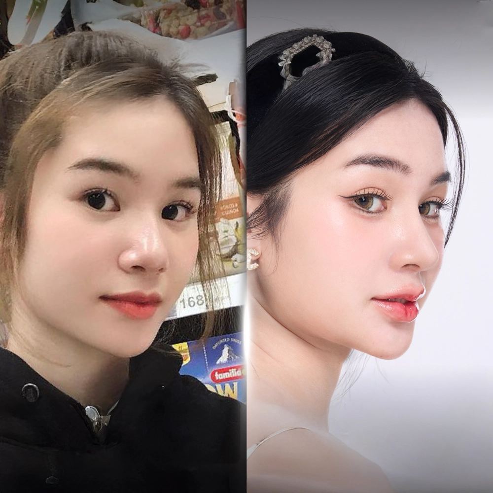 Sụn sườn sau khi lấy cần được xử lý và tạo hình phù hợp với từng vị trí trên mũi