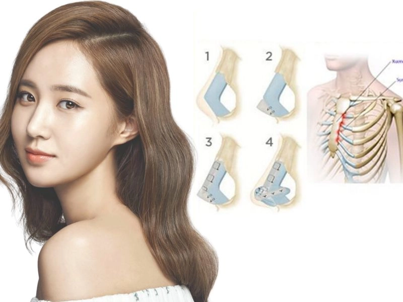 Tình trạng và cấu trúc mũi ảnh hưởng đến chi phí nâng mũi