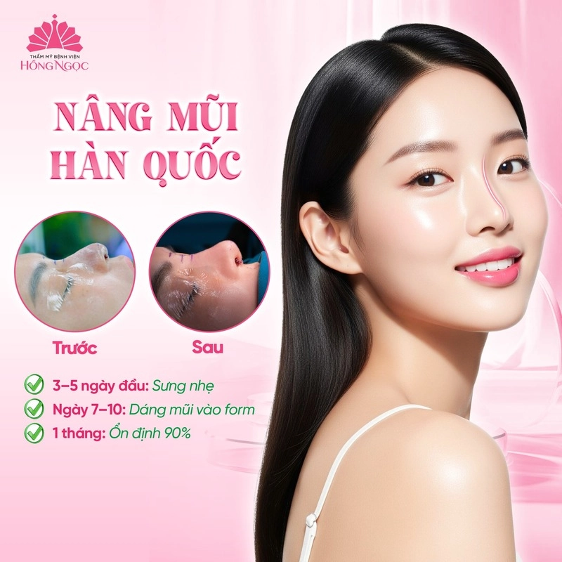 nâng mũi tại thẩm mỹ bệnh viện hồng ngọc