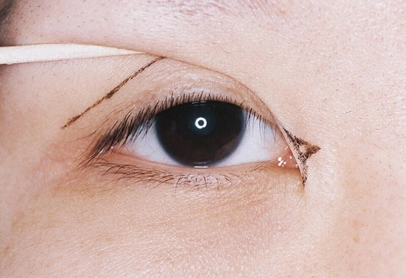 nếp mí rẻ quạt