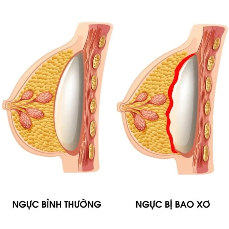 Nguyên nhân khiến nâng ngực bị co thắt bao xơ