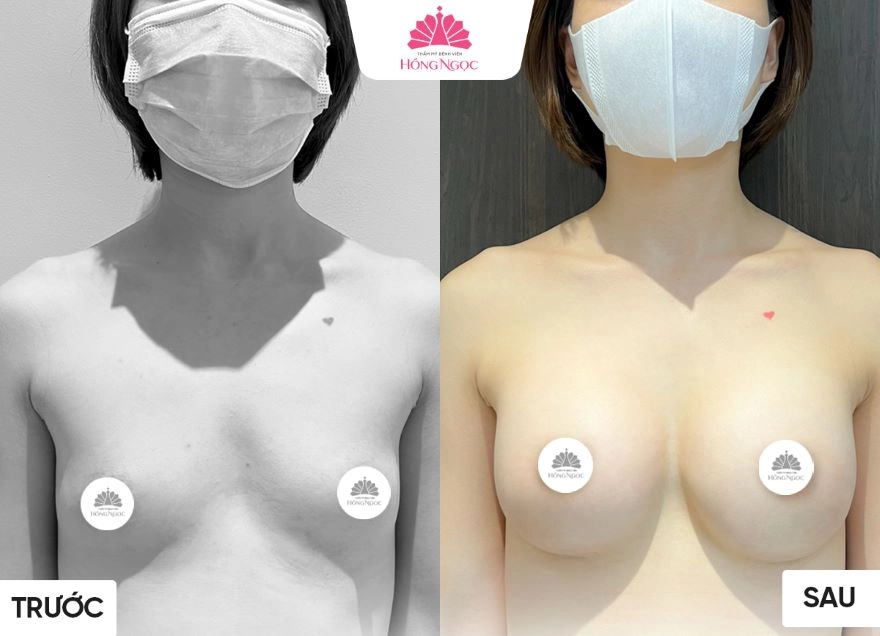 Nâng ngực bao lâu thì ổn định và hết đau?