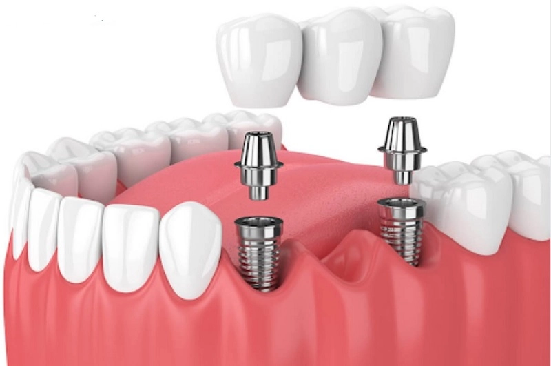 nguyên lý hoạt động của răng implant