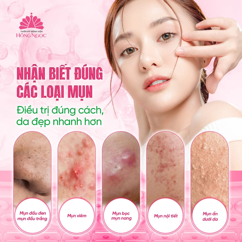 nguyên nhân gây mụn