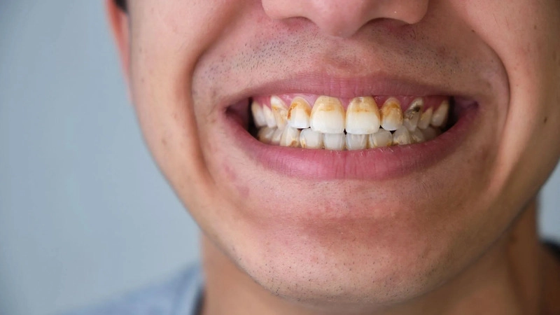 nguyên nhân viêm lợi phì đại