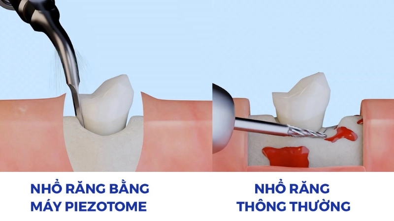 nhổ răng 8