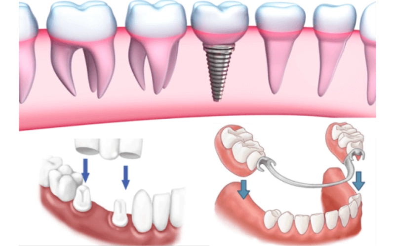 Nên trồng răng loại nào tốt và phù hợp nhất?