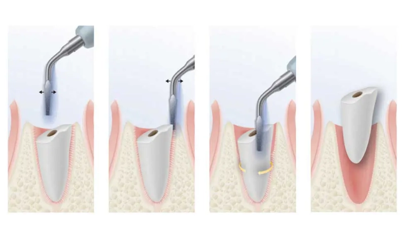 nhổ răng khôn không đau với công nghệ Piezotome