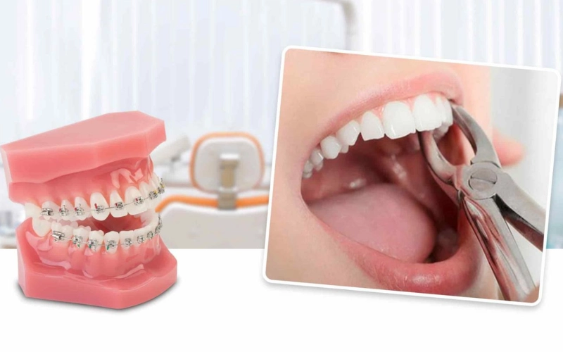 Niềng răng có cần nhổ răng không? 
