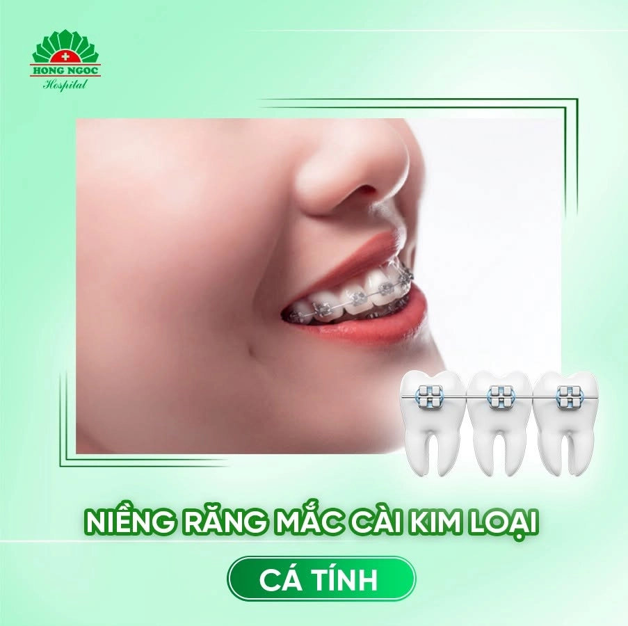 Niềng răng mắc cài kim loại