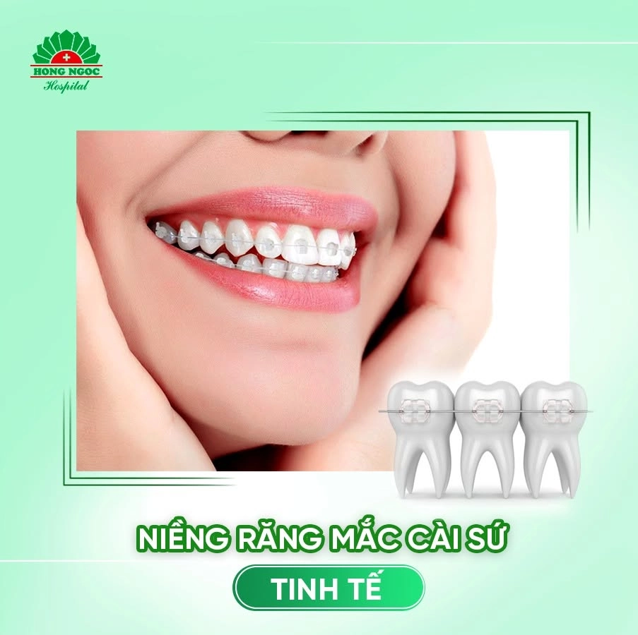 Niềng răng mắc cài sứ