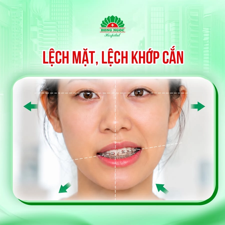 Niềng răng sẽ giúp loại bỏ răng hô, móm và lệch lạc