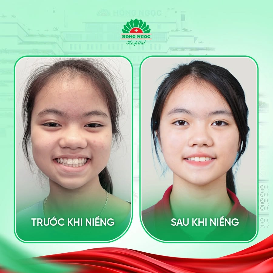 Niềng răng của người trưởng thành khác gì so với trẻ em?