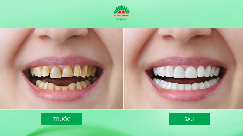 niềng răng hay bọc răng sứ