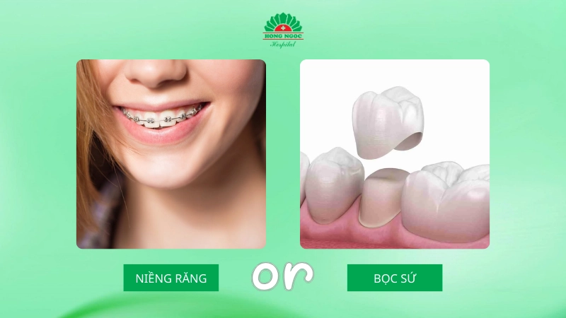 niềng răng hay bọc răng sứ