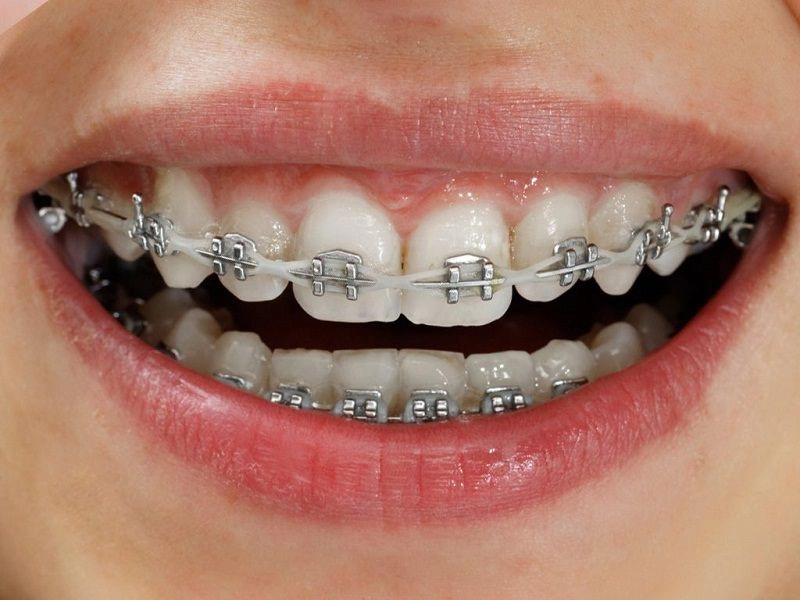 Niềng răng mắc cài sử dụng các khí cụ giúp kéo răng về đúng vị trí của nó.