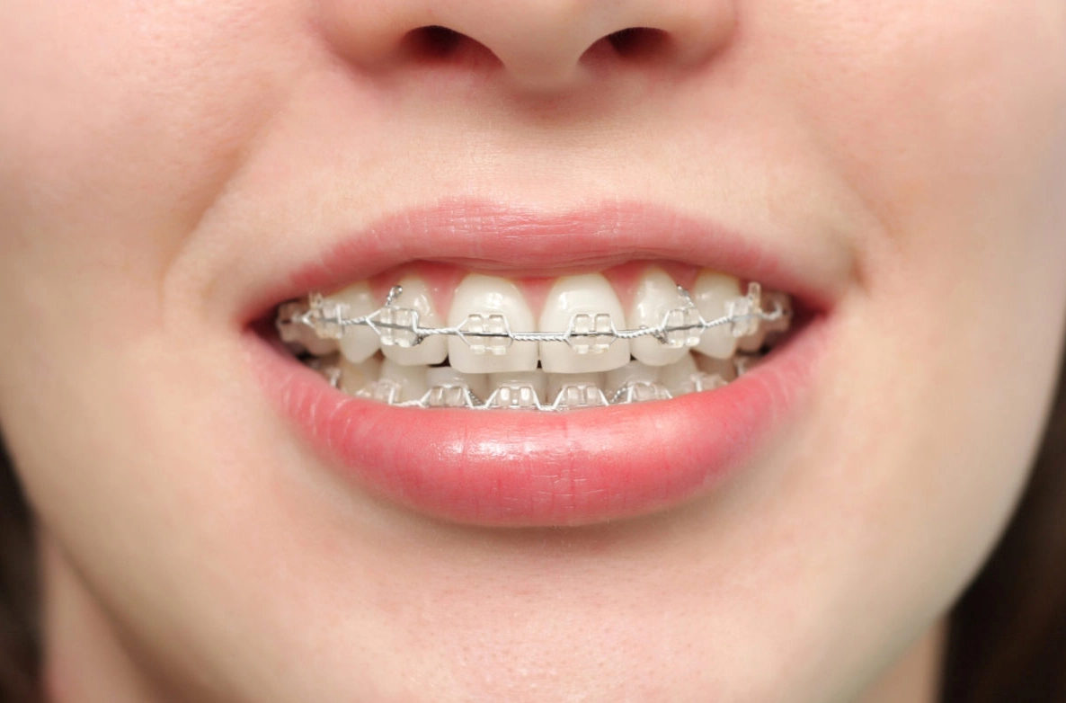 Niềng răng mắc cài truyền thống