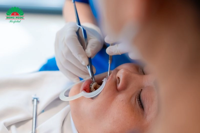 niềng răng mắc cài kim loại tại hồng ngọc